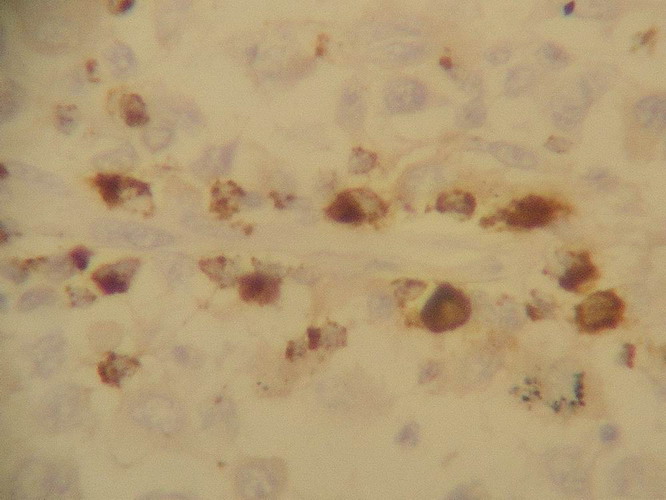 Fig. 13 - La expresin de Granzime B confirma la naturaleza citotxica de las clulas T perivasculares.